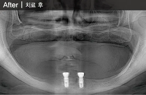 틀니마저 포기하신 환자분 치료 후